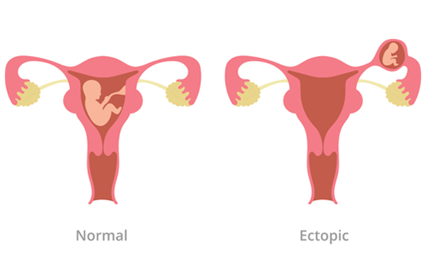 Ectopic Pregnancy